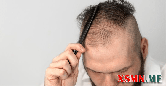 Ngủ mơ rụng tóc đánh đề số mấy?